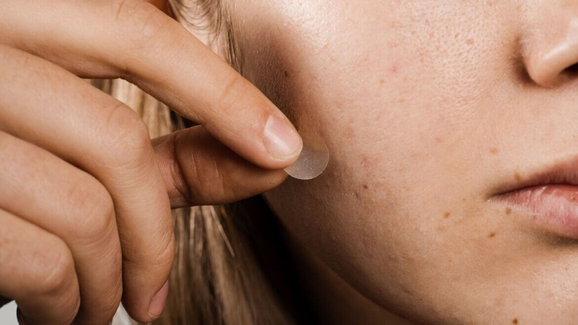 What are pimple patches? do they work?